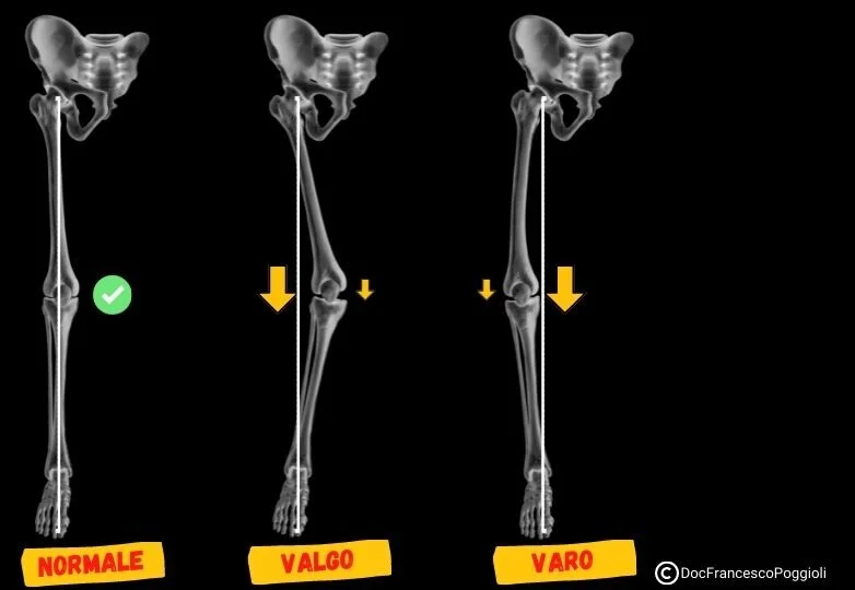 ginocchio varo valgo